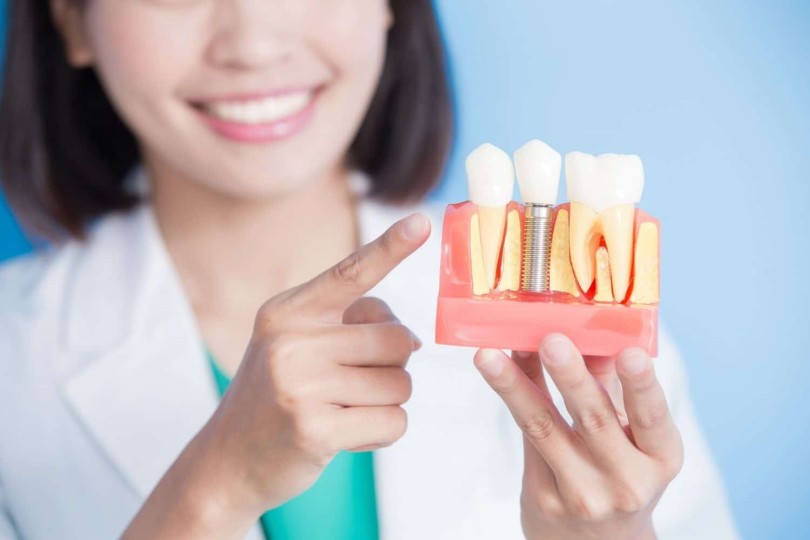 All-On-Four Implant System